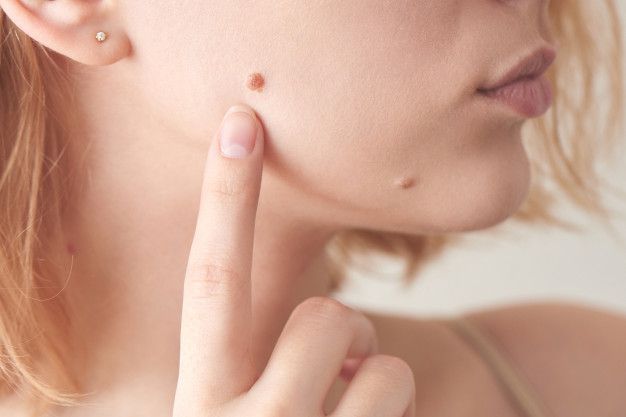Ko tavas dzimumzīmes stāsta par ādas vēzi?